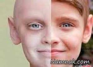 سرطان خون ، سرطان خون کودکان