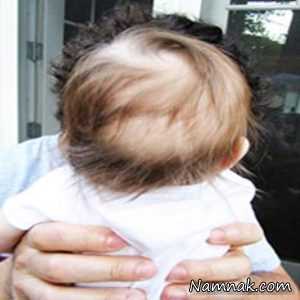 درمان ریزش مو کودکان