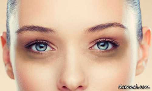 علت و درمان سیاهی دور چشم در هوای سرد.دلايل تيرگي زير چشم ها و راههاي درمان آن