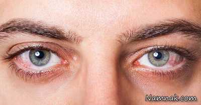 یوئیت چشم چیست؟ علائم و راه درمان بیماری یووئیت