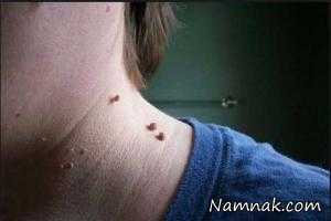 زائده های گوشتی ، زائده های گوشتی همرنگ پوست