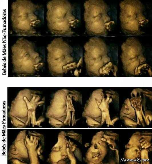 تصاویر وحشتناک از اثرات سیگار بر جنین