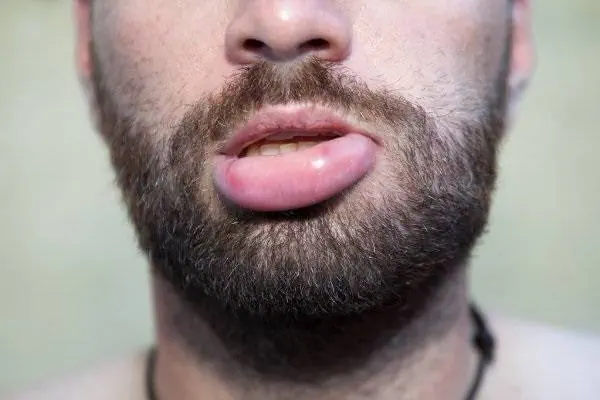 علائم آنژیوادم ارثی آنژیوادم ارثی