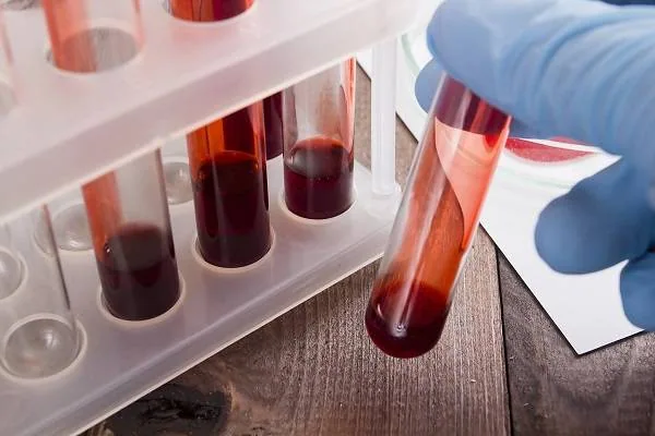 تشخیص آنژیوادم ارثی انواع آنژیوادم ارثی