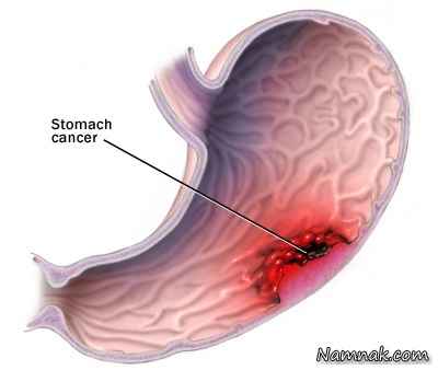 نتیجه تصویری برای سرطان معده