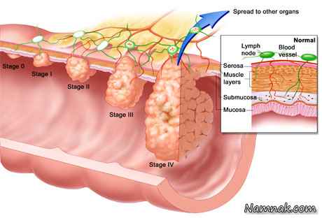نتیجه تصویری برای سرطان روده