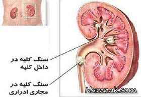 سنگ کلیه و روش های درمان ان. عکس سنگ کلیه سنگ کلیه و روش های درمان ان. عکس سنگ کلیه