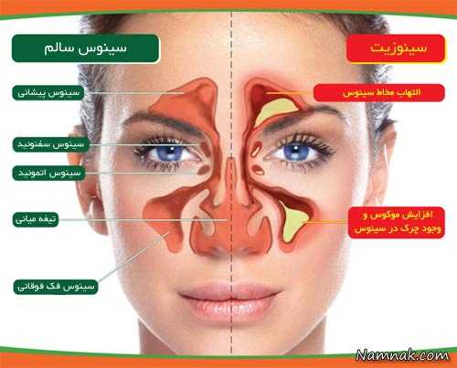مشکلات سینوسی و درمان آن انسداد بینی