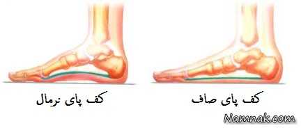 علت بیماری کف پای صاف ، کف پای صاف و عوارض آن ، درمان کف پای صاف