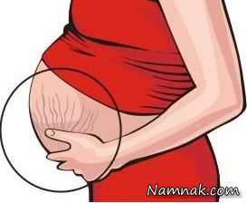 درمان جوش شکم در بارداری