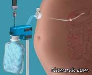 دستگاه لاغری ، دستگاه لاغر کننده
