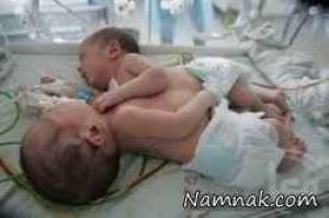 دوقلوهای به هم چسبیده