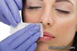 موهای زائد پشت لب ، رفع موهای زائد پشت لب