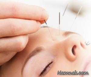 طب سوزنی صورت ، طب سوزنی برای صورت
