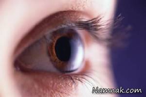 خشکی چشم ، سندرم خشکی چشم