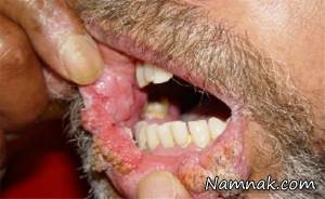 طاعون ، طاعون خیارکی