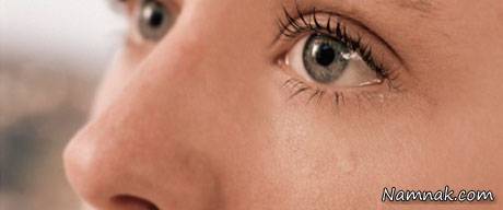 درمان اشک ریزش چشم