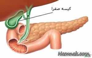 کیسه صفرا ، برداشتن کیسه صفرا