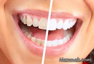 دندان ، بلیچینگ دندان