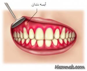 آبسه دندان ، درمان خانگی آبسه دندان