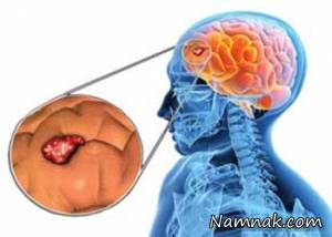 تومورهای مغزی ، سرطان مغز