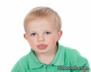 لکنت زبان ، لکنت ناگهانی زبان