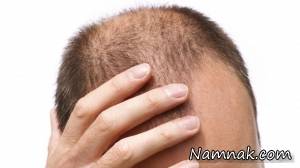 ریزش مو در جوانی ، علت ریزش مو در جوانی