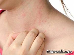 کهیر بعد از زایمان ، علت کهیر بعد از زایمان