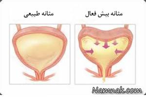 مثانه بیش فعال