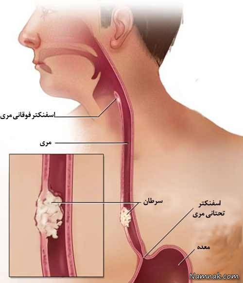 انواع سرطان های دستگاه گوارش