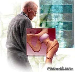 پوکی استخوان ، علل پوکی استخوان