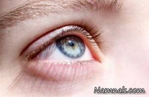 نزدیک بینی ، درمان نزدیک بینی