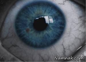 آلزایمر