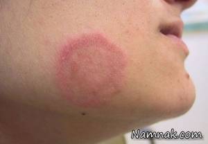 قارچ ، عفونت های قارچی پوست