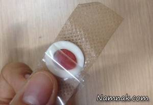 میخچه انگشت پا ، میخچه کف پا چیست