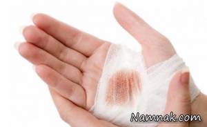 بندآوردن خونریزی ، بریدگی و خونریزی