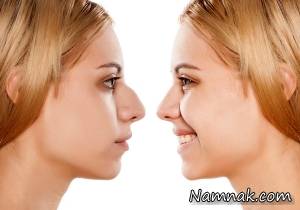 انحراف بینی ، ناهنجاری های تیغه بینی