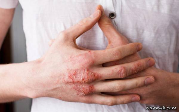 خارش پوست و ارتباط آن با آلرژی خشکی و خارش پوست