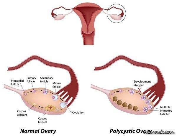 درمان تنبلی تخمدان 