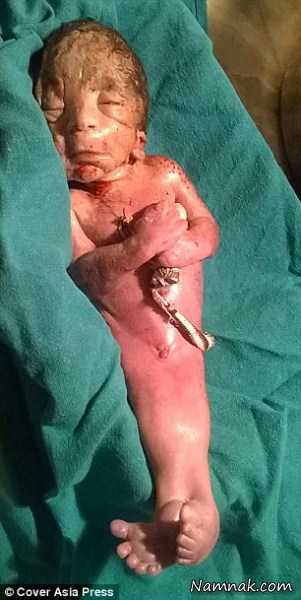 نوزاد عجیب ، نوزاد مبتلا به سندرم پری دریایی ، عکس بچه عجیب الخلقه