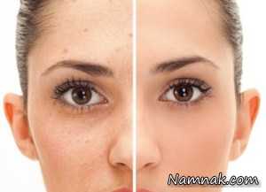 لکه های قهوه ای پوست ، لکه های قهوه ای پوست صورت