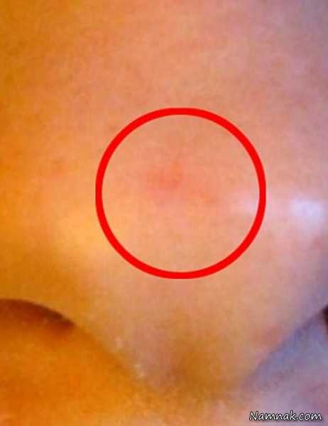 عکس بینی زن بینی زن ، داروی ضد سرطان تقلبی ، عکس بینی ترسناک