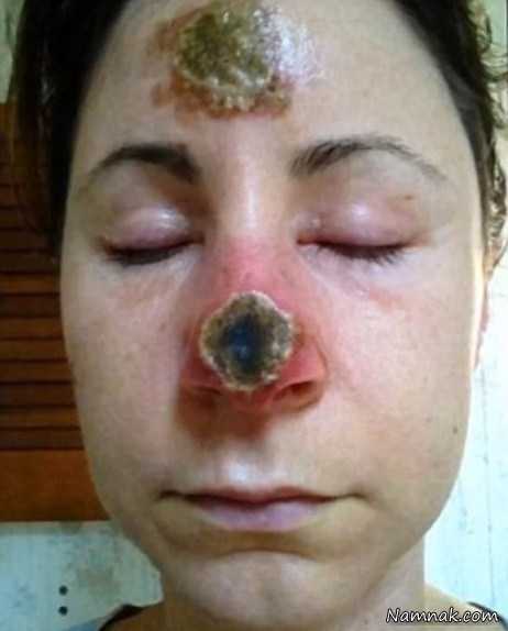 بینی زن ، عکس بینی ترسناک ، بینی خورده شده ی یک زن