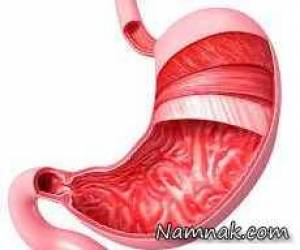 علائم زخم معده ، زخم معده ، استفراغ خونی ، مدفوع تیره نشانه چیست علائم زخم معده