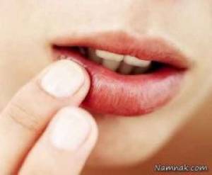 علائم دهانی ایدز ، علائم دهانی بیماری ایدز