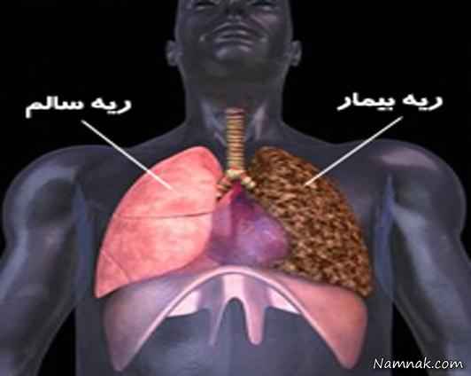 سرطان ریه و درمان آن