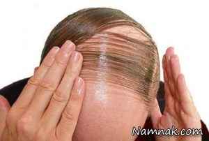 درمان ریزش مو ، ریزش مو مردان
