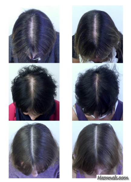درمان ریزش مو در خانمها