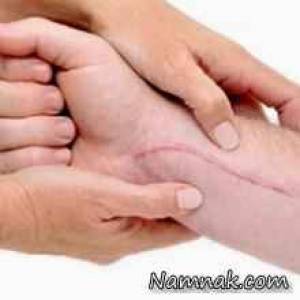 جای زخم و بخیره ، از بین بردن بخیه