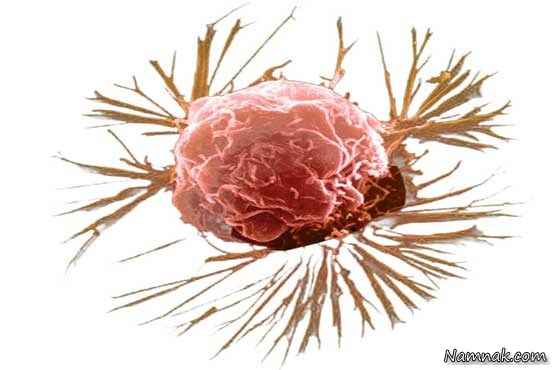 سرطان پستان ، سرطان سینه ، نشانه هاي سرطان سينه در زنان